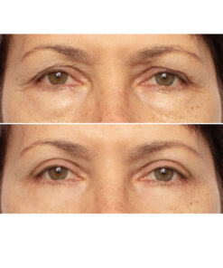 Microbiome Eye Cream Eyes Before and After
