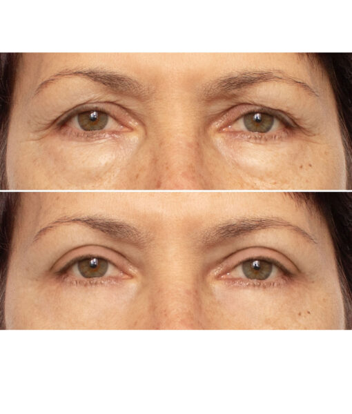 Microbiome Eye Cream Eyes Before and After