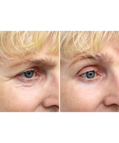 Microbiome Eye Cream Before and After