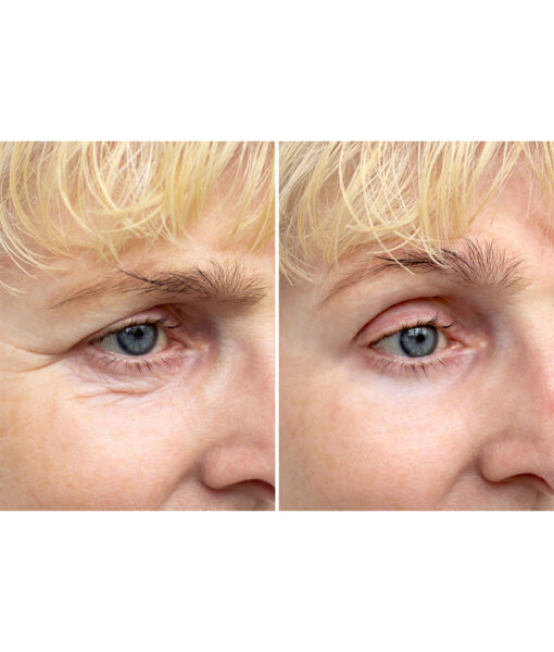 Microbiome Eye Cream Before and After